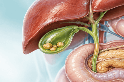 Gallbladder Stones