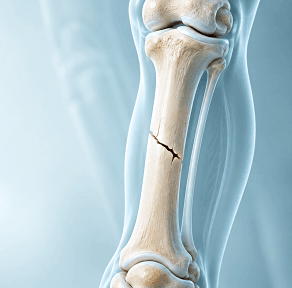 bone fractures