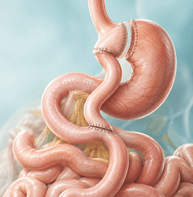 Laparoscopic Gastric Bypass Roux-en-Y at Arihant Hospitals