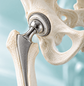Total Hip Replacement at Arihant Hospitals